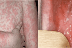 NHỮNG ĐIỀU CHA MẸ CẦN BIẾT KHI CHĂM SÓC TRẺ MẮC BỆNH SỞI TẠI NHÀ